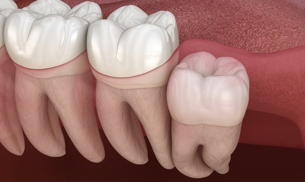 Как понять, что растет ретинированный зуб мудрости?