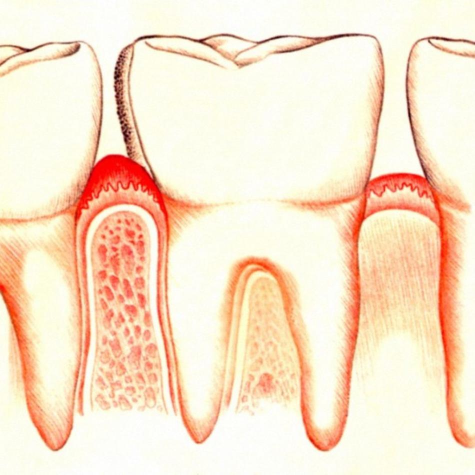 Как лечить хронический и острый гингивит?