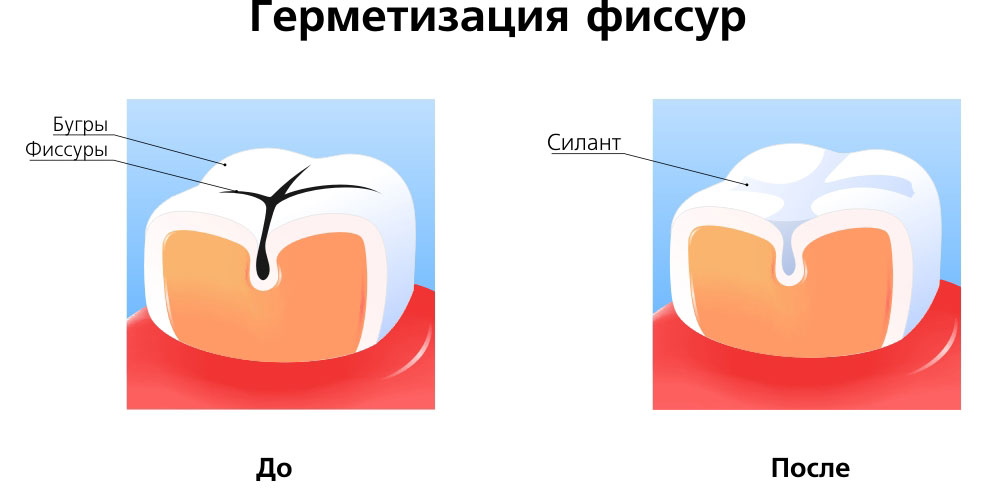 Герметизация зубов